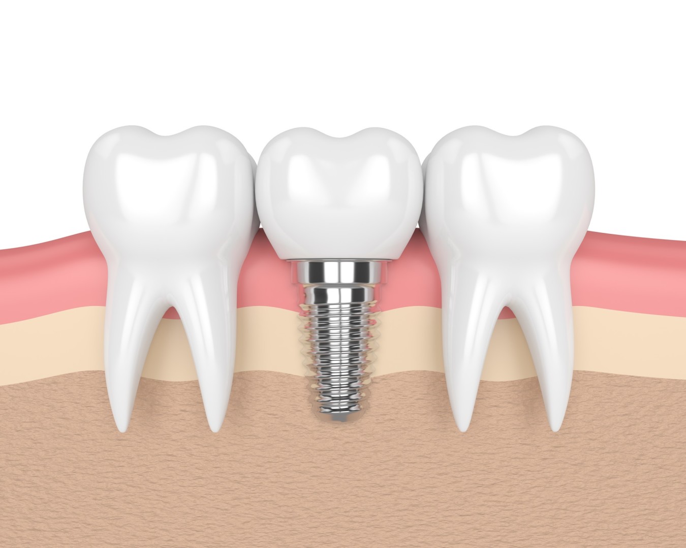 Implant dentaire